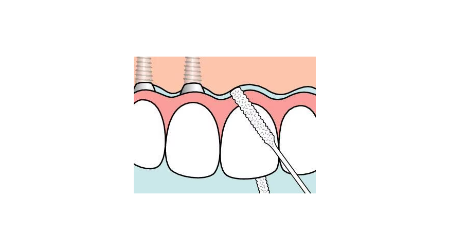 Dantų siūlas implantams ir tiltams: kaip pasirinkti ir naudoti?