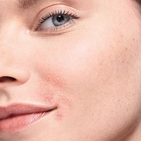 Atopiskais dermatīts